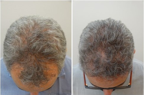 Antes x Depois 1
