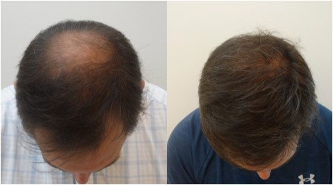 Antes x Depois 10