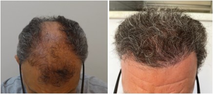 Antes x Depois 11
