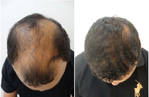 Antes x Depois 2