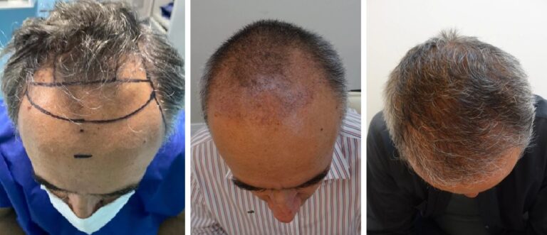 Antes x Depois 4