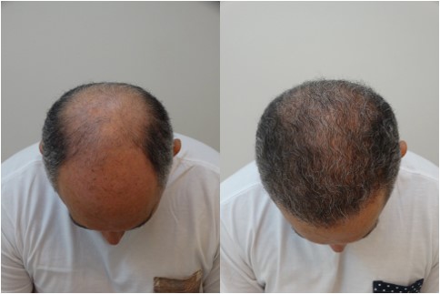 Antes x Depois 9